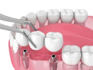 Dental Implant