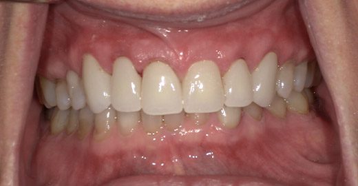 Case-2-Upper-Arch-Rehab-After