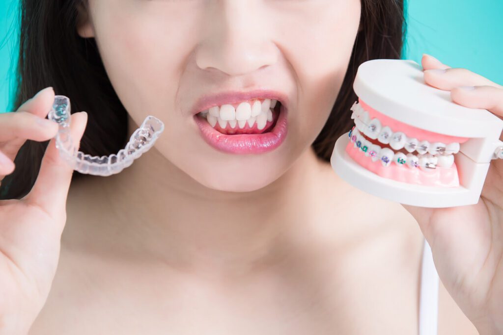 Invisalign Vs Braces