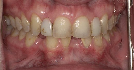 Case-6-Bridges-Before Case-6-Bridges-Before