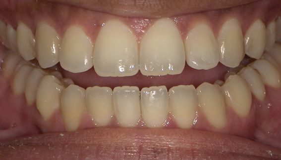 10_9 Invisalign B&A 2 10_9 Invisalign B&A 2