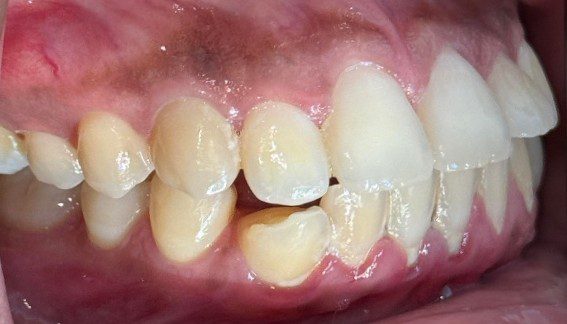10_9 Invisalign B&A 3 10_9 Invisalign B&A 3