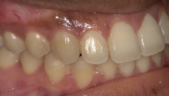 10_9 Invisalign B&A 4 10_9 Invisalign B&A 4