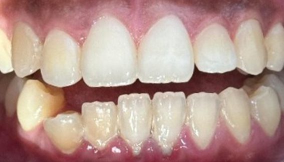 10_9 Invisalign B&A_ 10_9 Invisalign B&A_